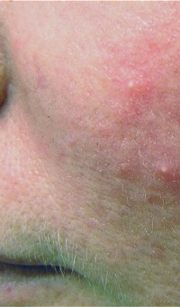 Rosacea basics: 101